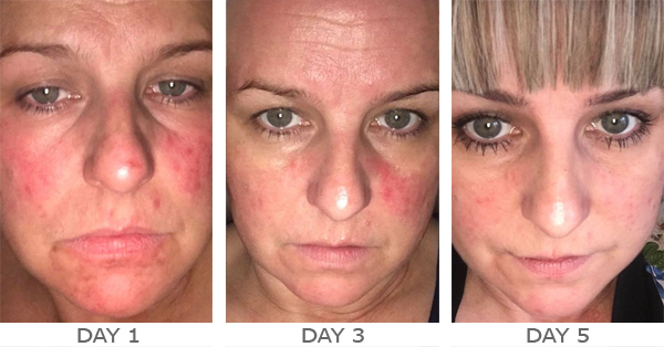 rosacea-skin-care