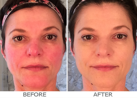 rosacea-skincare