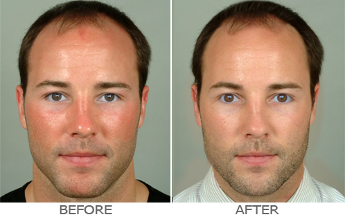 rosacea-skincare